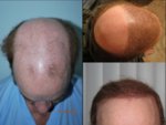 Hair Transplant